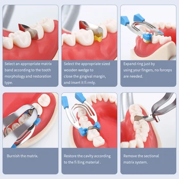 Azdent Dentare Matrice Sectionale Metal Clip De Primăvară Matrice Inele De Matrice Cleme Pene De Instrumente Stomatologice Instrumente Dentare