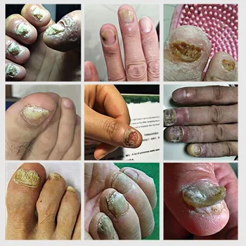 LANBENA Unghiilor Fungice Tratament de Îngrijire de Picioare Esența Onicomicoza Paronichie Anti-Fungice Infecție Îndepărtare Gel de Deget Picior Grija de Reparații
